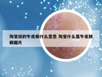 淘宝说的牛皮癣什么意思 淘宝什么是牛皮肤癣图片