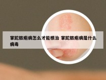 掌跎脓疱病怎么才能根治 掌跎脓疱病是什么病毒