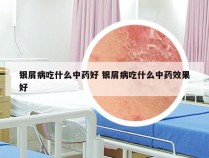 银屑病吃什么中药好 银屑病吃什么中药效果好