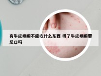 有牛皮病癣不能吃什么东西 得了牛皮病癣要忌口吗