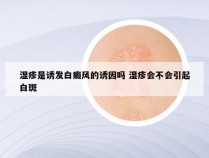 湿疹是诱发白癜风的诱因吗 湿疹会不会引起白斑