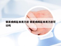 银屑病痒起来用刀刮 银屑病痒起来用刀刮可以吗