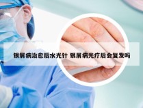 银屑病治愈后水光针 银屑病光疗后会复发吗