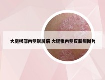 大腿根部内侧银屑病 大腿根内侧皮肤癣图片