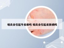 咽炎会引起牛皮癣吗 咽炎会引起皮肤病吗