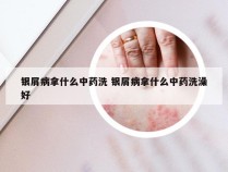 银屑病拿什么中药洗 银屑病拿什么中药洗澡好