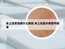 身上经常张癣什么原因 身上老是长癣是咋回事