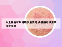 头上有癣可以用碘伏清洗吗 头皮癣可以用碘伏洗头吗