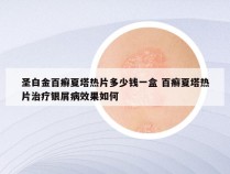 圣白金百癣夏塔热片多少钱一盒 百癣夏塔热片治疗银屑病效果如何