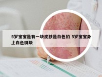 5岁宝宝是有一块皮肤是白色的 5岁宝宝身上白色斑块