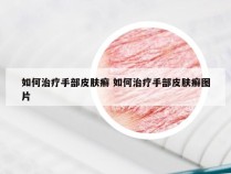 如何治疗手部皮肤癣 如何治疗手部皮肤癣图片