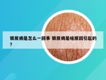 银屑病是怎么一回事 银屑病是啥原因引起的?