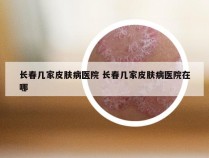 长春几家皮肤病医院 长春几家皮肤病医院在哪