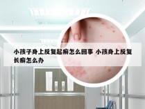 小孩子身上反复起癣怎么回事 小孩身上反复长癣怎么办