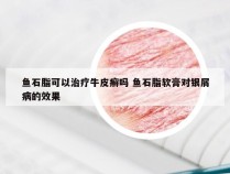 鱼石脂可以治疗牛皮癣吗 鱼石脂软膏对银屑病的效果