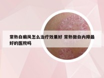 常熟白癜风怎么治疗效果好 常熟做白内障最好的医院吗