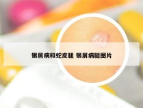 银屑病和蛇皮腿 银屑病腿图片