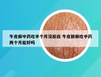 牛皮癣中药吃半个月没反应 牛皮肤癣吃中药两个月能好吗