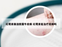 红霉素肠溶胶囊牛皮癣 红霉素能治疗皮癣吗