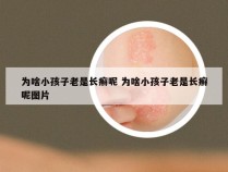 为啥小孩子老是长癣呢 为啥小孩子老是长癣呢图片