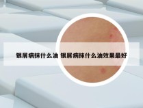 银屑病抹什么油 银屑病抹什么油效果最好