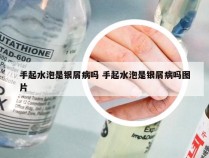 手起水泡是银屑病吗 手起水泡是银屑病吗图片