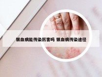 银血病能传染厉害吗 银血病传染途径