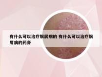 有什么可以治疗银屑病的 有什么可以治疗银屑病的药膏