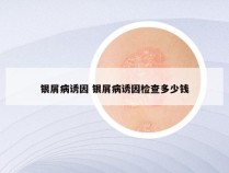 银屑病诱因 银屑病诱因检查多少钱