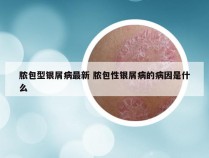 脓包型银屑病最新 脓包性银屑病的病因是什么