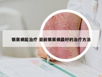 银屑病能治疗 目前银屑病最好的治疗方法