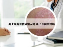 身上长癣会传染别人吗 身上长癣会好吗