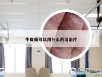 牛皮癣可以用什么药浴治疗