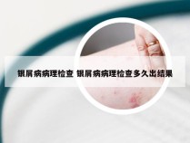 银屑病病理检查 银屑病病理检查多久出结果