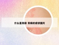 什么是骨藓 骨癣的症状图片