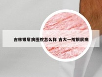 吉林银屑病医院怎么样 吉大一院银屑病