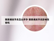 银屑病关节炎怎么怀孕 银屑病关节炎影响生育吗