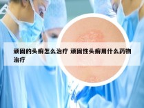 顽固的头癣怎么治疗 顽固性头癣用什么药物治疗