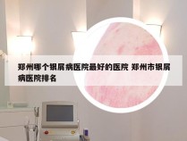 郑州哪个银屑病医院最好的医院 郑州市银屑病医院排名