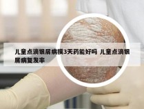 儿童点滴银屑病摸3天药能好吗 儿童点滴银屑病复发率