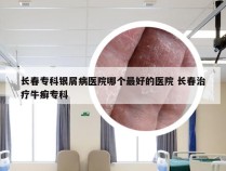 长春专科银屑病医院哪个最好的医院 长春治疗牛癣专科