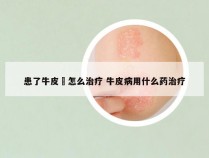 患了牛皮廯怎么治疗 牛皮病用什么药治疗