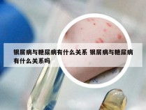 银屑病与糖尿病有什么关系 银屑病与糖尿病有什么关系吗