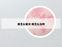 癣怎么解决 癣怎么治啊