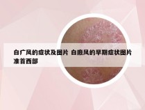 白疒风的症状及图片 白廒风的早期症状图片准首西部