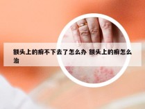 额头上的癣不下去了怎么办 额头上的癣怎么治