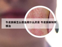 牛皮肤癣怎么根治用什么药膏 牛皮肤癣如何根治