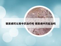 银屑病可以用中药治疗吗 银屑病中药能治吗