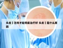 头皮廯怎样才能彻底治疗好 头皮庝是什么原因