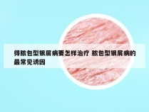 得脓包型银屑病要怎样治疗 脓包型银屑病的最常见诱因